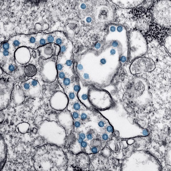 Transmission electron microscopic image of an isolate from the first U.S. case of COVID-19, formerly known as 2019-nCoV. The spherical viral particles, colorized blue, contain cross-section through the viral genome, seen as black dots.